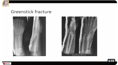 Thumbnail of Dr Rudraprasad's talk on Distal Radial Fracture